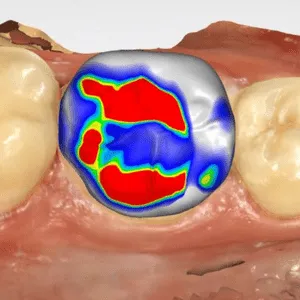 laboratorio dental digital para incrustaciones dentales